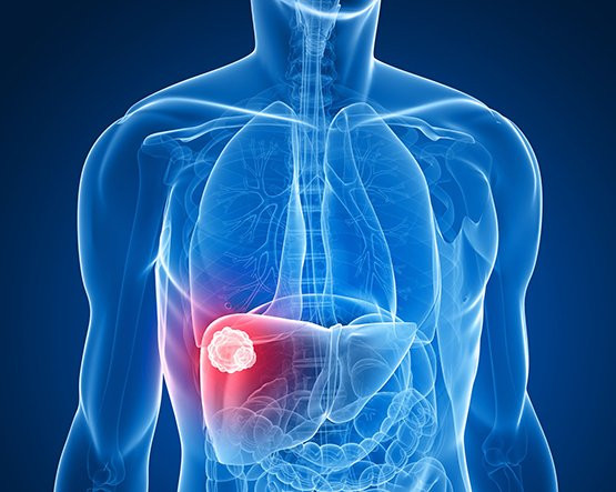 Liver Cancer Treatment in Mumbai