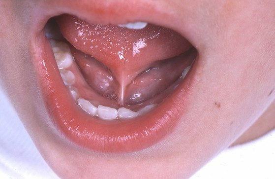 Tongue Tie Surgery Cost in Mumbai