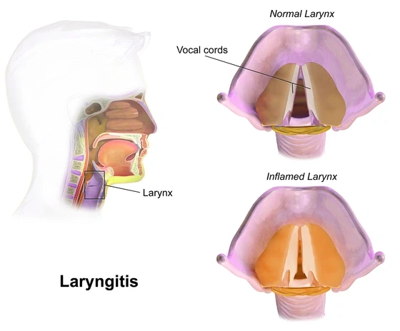 Laryngitis Treatment In Mumbai