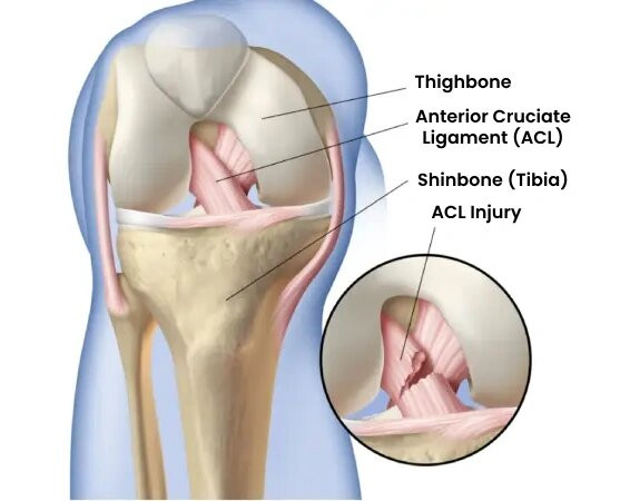 ACL Reconstruction surgery in Dubai