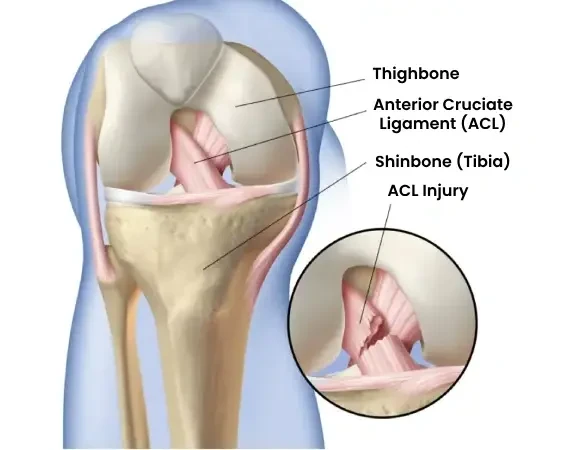 Best ACL Surgery in Dubai with Dr. Azam Badar Khan Doctor Near Me Best ACL Surgery in Dubai