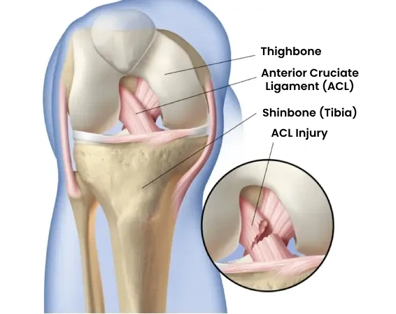 Best ACL Surgery in Dubai