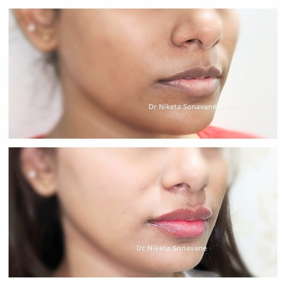 skin whitening treatment in Mumbai