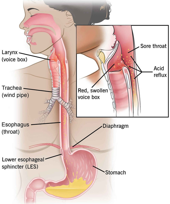 esophagealstricture.jpg