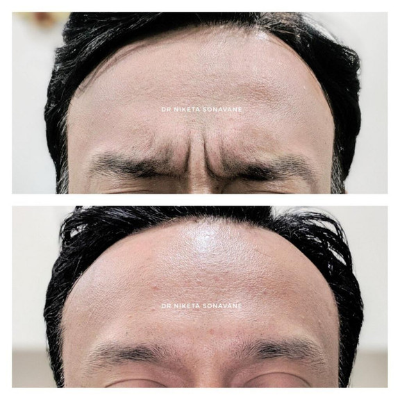 frownbotoxinmumbaibeforeafter1024x1024.jpg