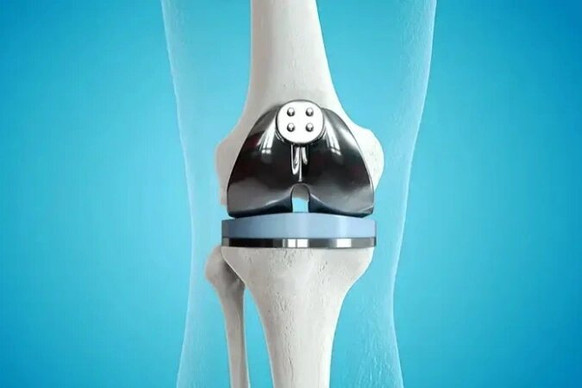 Knee Replacement in Sharjah – Dr. Azam Khan