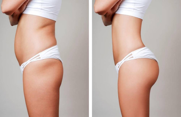liposuction cost in mumbai