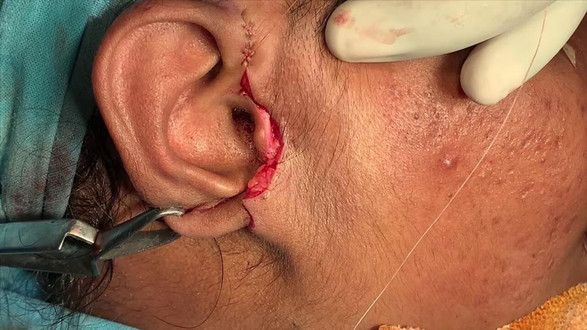 Facelift Surgery in Mumbai