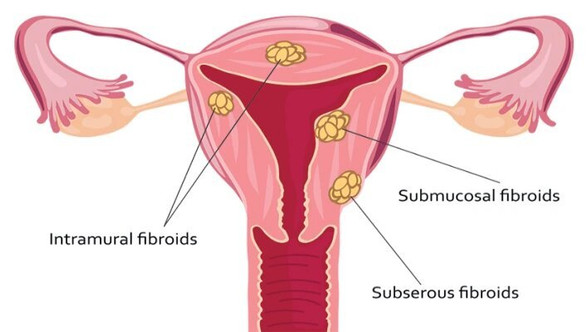 Fibroid Removal in Mumbai: Dr. Maitreyee Parulekar