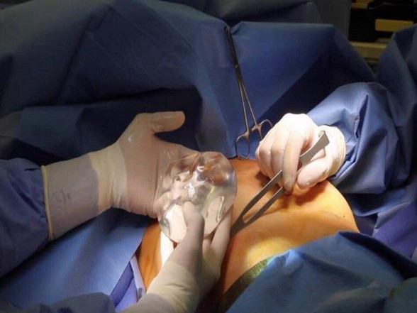 Breast Augmentation in Mumbai: Dr. Siddharth Prakash