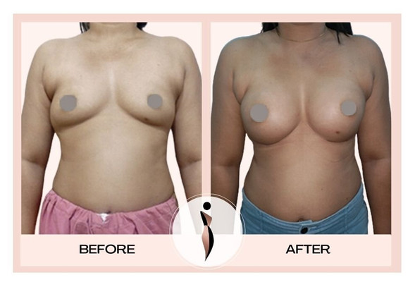 Breast Augmentation in Mumbai