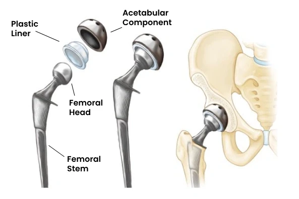 Hip Replacement in Bengaluru