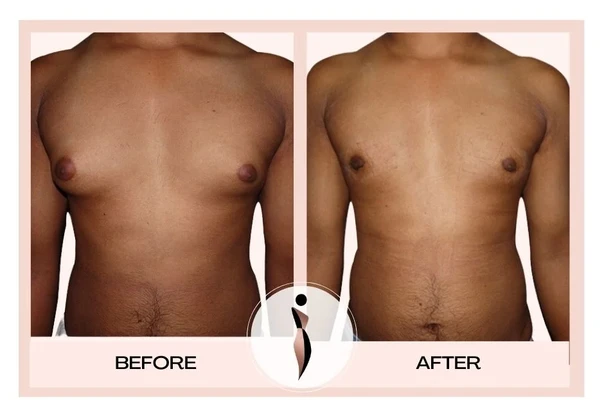 GYNAECOMASTIA.webp