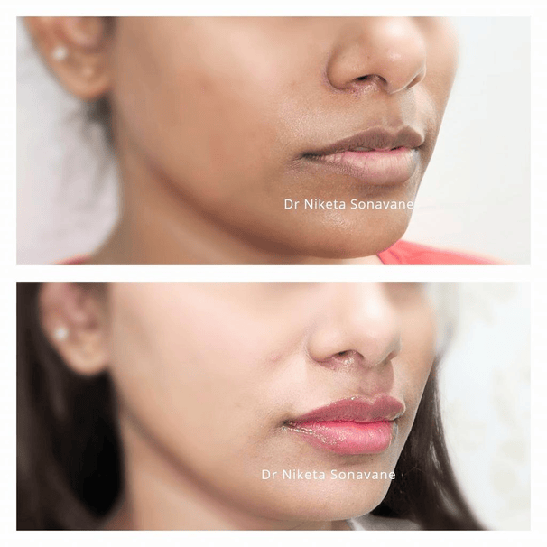 Dark Lips Treatment in Mumbai: Dr. Niketa Sonavane