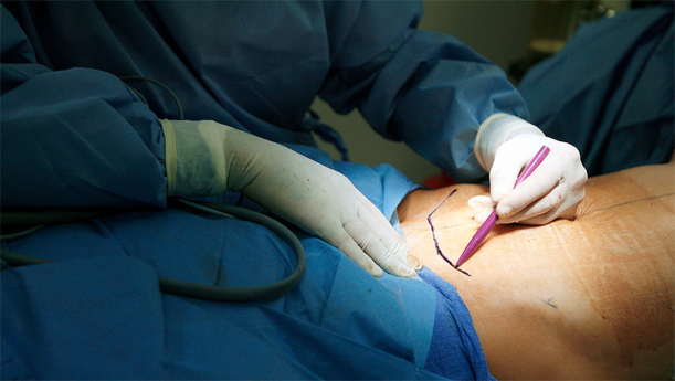Tummy Tuck Surgery in Mumbai
