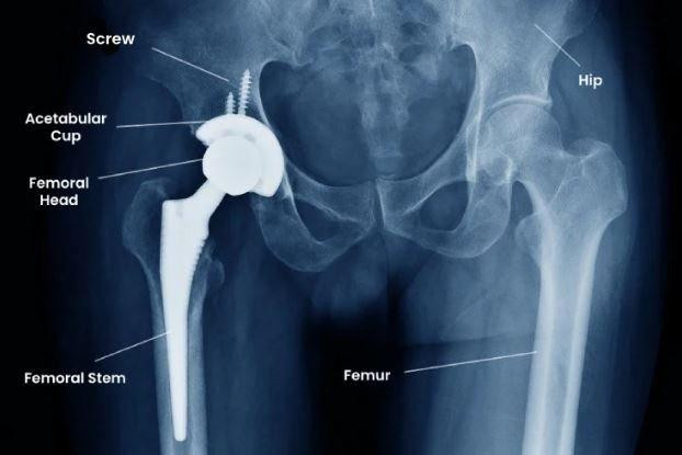 Total Hip Replacement surgery in Bangalore