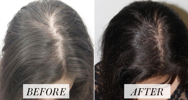 Hair Loss Treatment in Mumbai with Dr. Niketa Sonavane