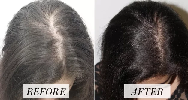 Hair Loss Treatment in Mumbai | Expert Insights Doctor Near Me hair loss treatment in mumbai