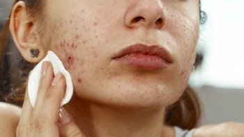 What Is Acne? Symptoms, Causes, Treatments, & More - GoodRx