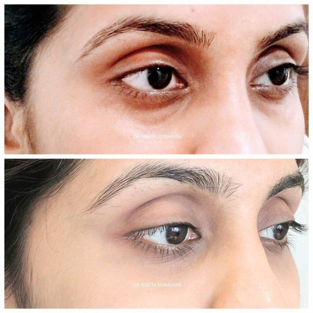 Dark Circle Removal in Mumbai