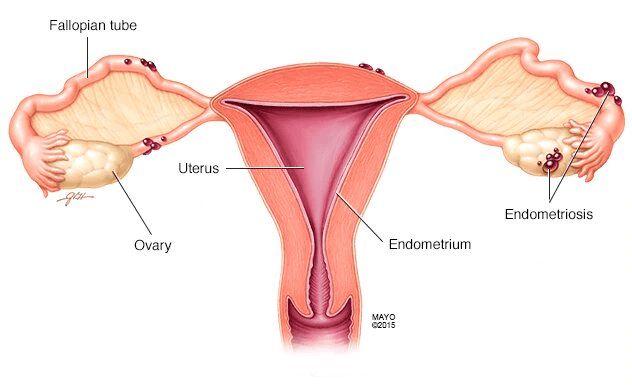 Endometriosis surgery in Mumbai