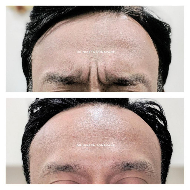 frownbotoxinmumbaibeforeafter1024x1024.jpg