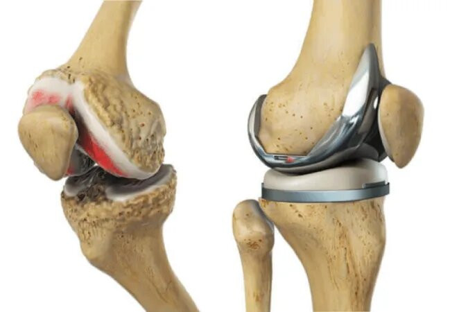 Knee Replacement Surgery in Dubai, UAE