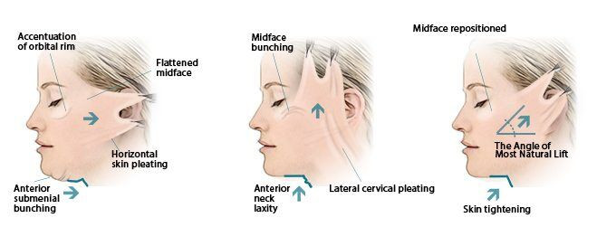 Facelift Surgery in Mumbai