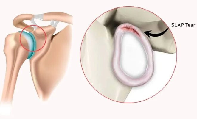 Frozen Shoulder Treatment in Bangalore: Dr. Poonnana K.M