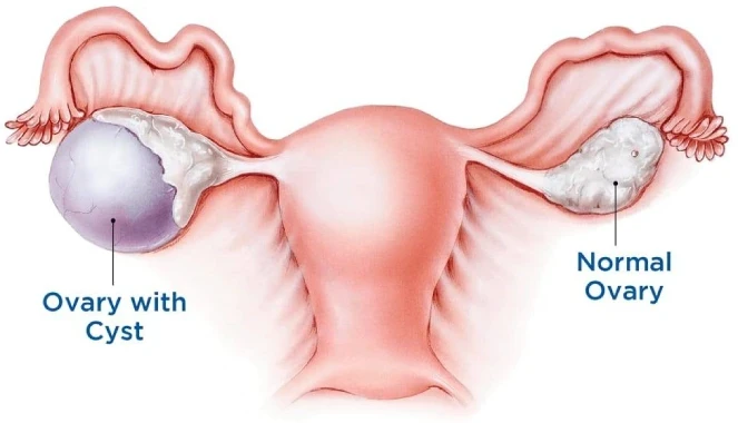 ovarian cyst surgery in mumbai