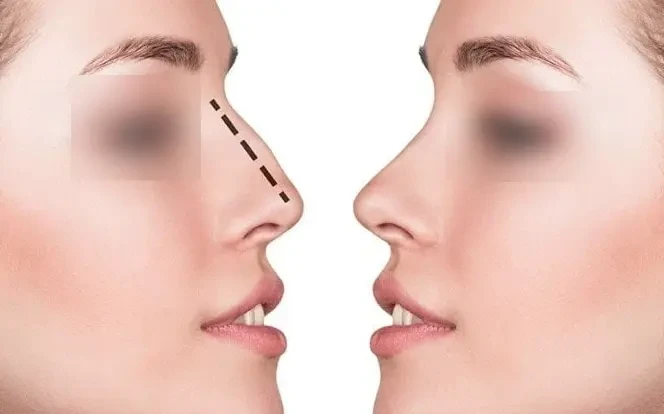 septoplasty surgery in mumbai