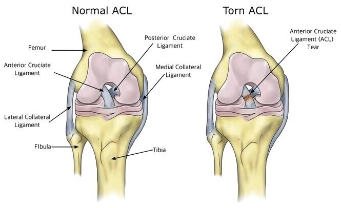 Arthroscopic ACL Reconstruction in Bangalore – Dr. Ponnanna K.M