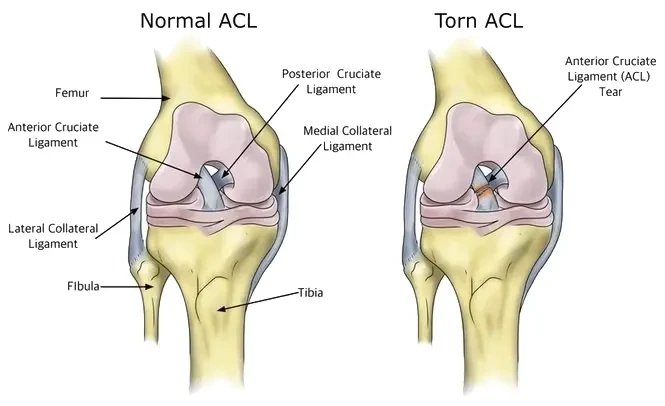 Arthroscopic ACL Reconstruction in Bangalore