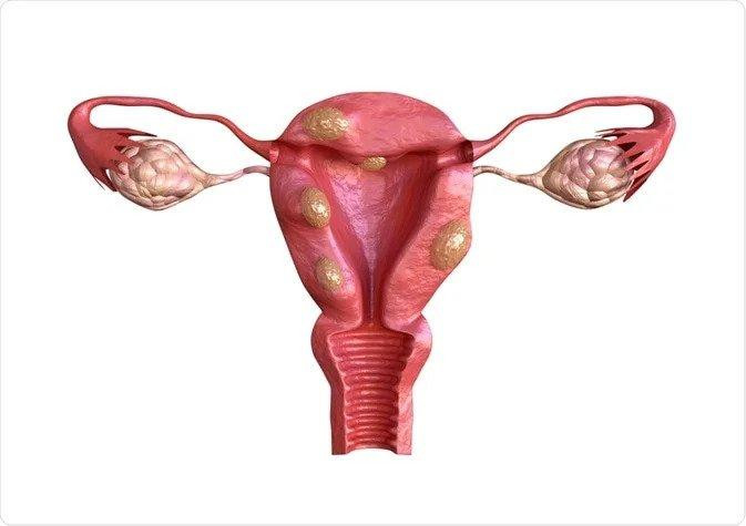 fibroid removal in mumbai