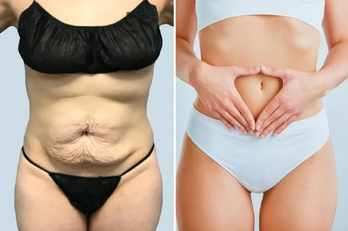 Tummy Tuck in Mumbai