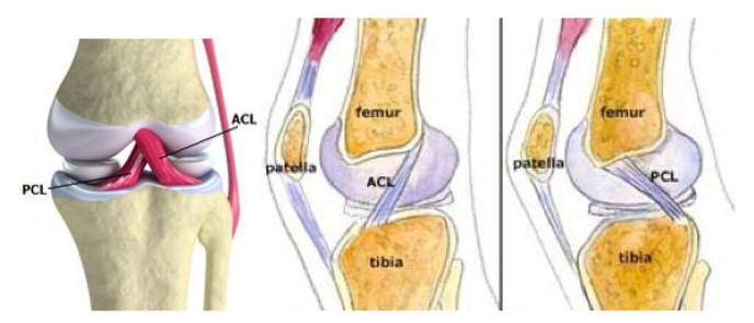 Arthroscopic PCL Reconstruction in bengalore
