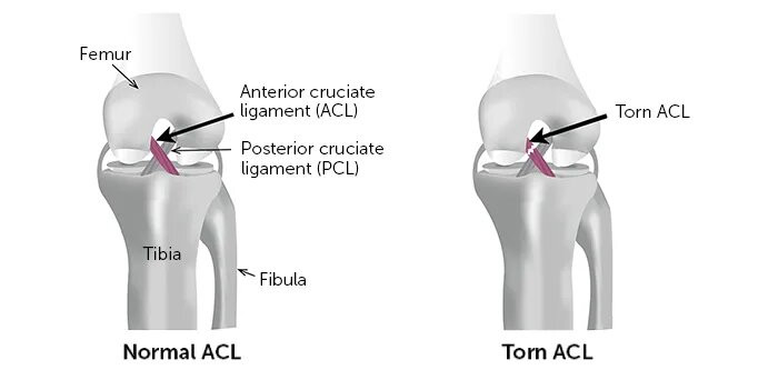 Best ACL Surgery in Dubai, UAE