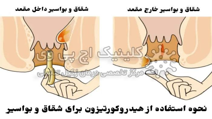 طریقه مصرف پماد هیدروکورتیزون