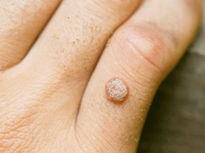 wart removal treatment mumbai