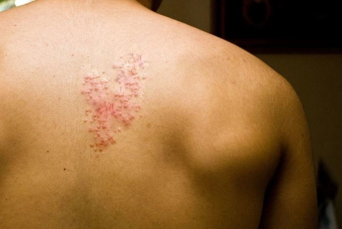 herpes zoster treatment in mumbai