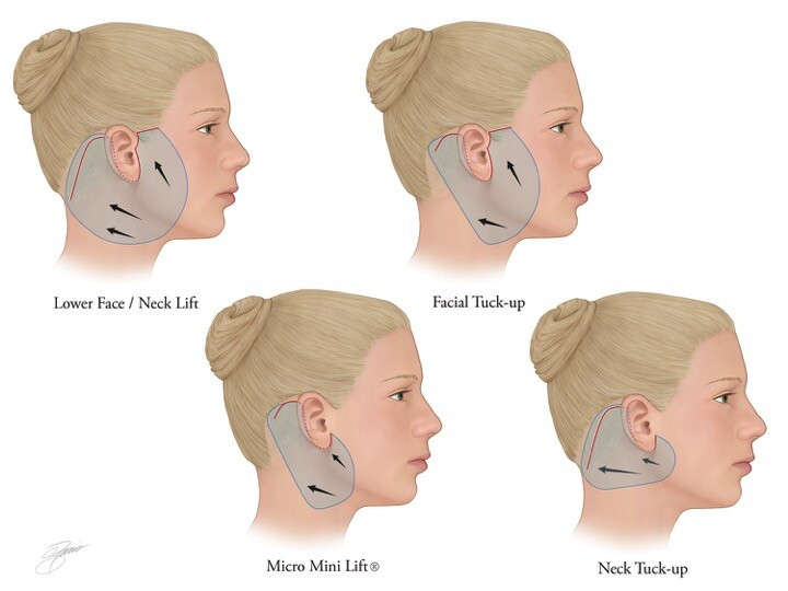 Facelift Surgery in Mumbai – Dr. Siddharth Prakash