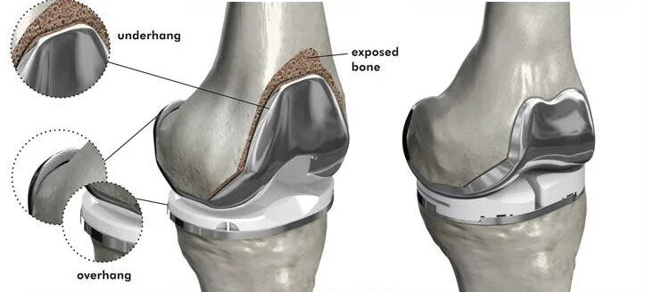 Knee Replacement Surgery in Dubai