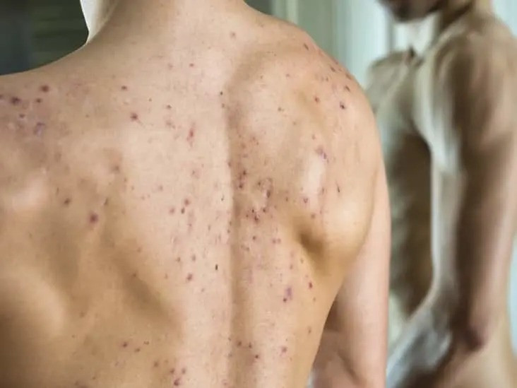 body acne treatment in mumbai