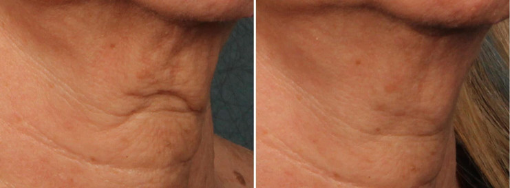 ageingnecktreatment.jpg