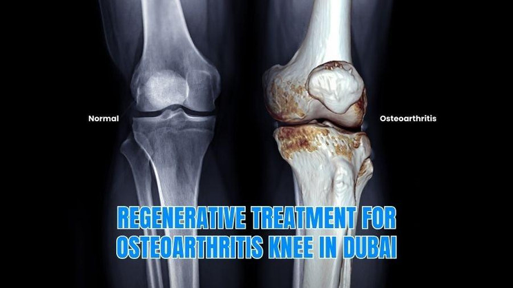 Knee Osteoarthritis Treatment Dubai – Expert Care with Dr. Azam Badar Khan Doctor Near Me knee osteoarthritis treatment dubai