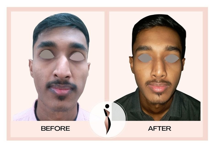 Best Rhinoplasty Surgeon in Mumbai – Dr. Amiti Shah
