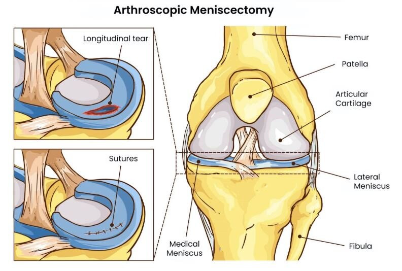 Arthroscopic Meniscus Surgeries in Banglore