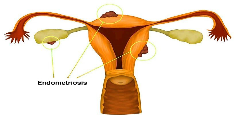 Endometriosis Treatment in Mumbai – Dr. Maitreyee Parulekar Endometriosis Treatment in Mumbai – Dr. Maitreyee Parulekar