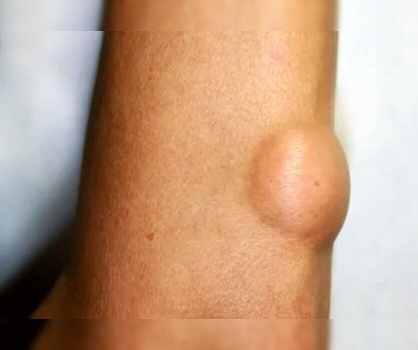 Lipoma Removal Surgery in Navi Mumbai