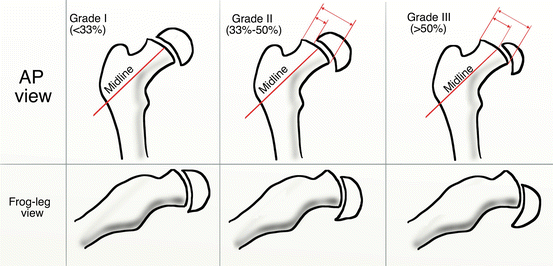 Slipped Capital Femoral Epiphysis | SpringerLink